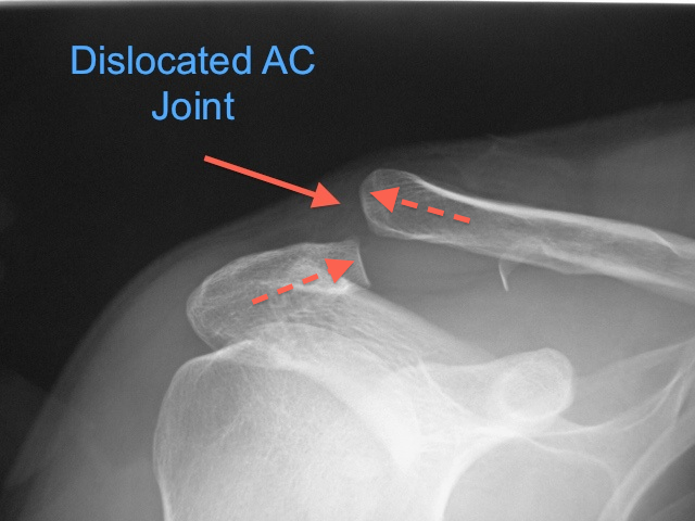 Validering Motherland Klimatiske bjerge Acromioclaivicular Joint Dislocation - Dr Terry Hammond